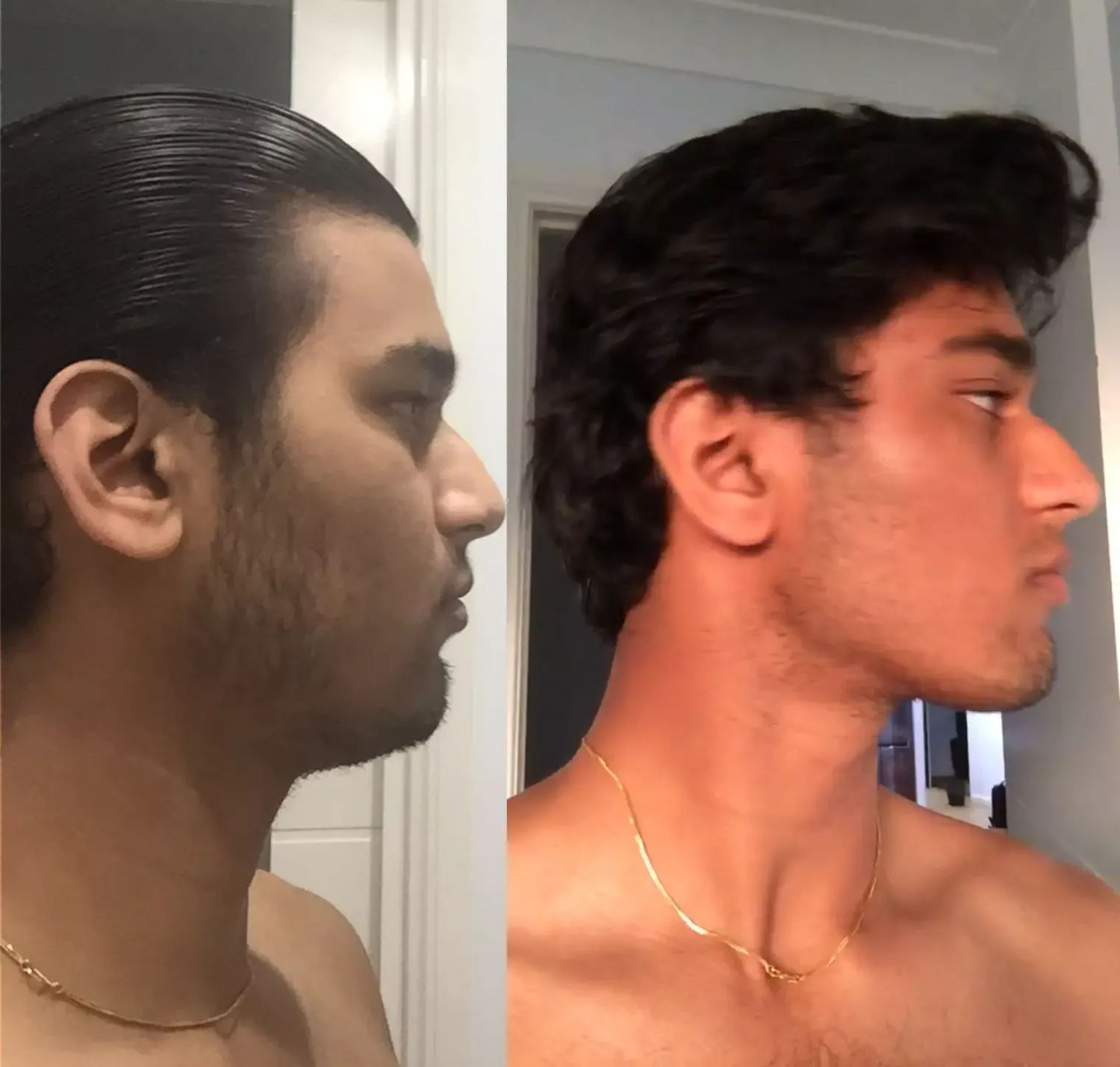 Man transforms his jawline after chewing mastic gum